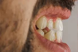 Image result for Gingivitis