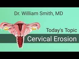 Cervical Erosion For Medical Students Cervical Ectropion Youtube
