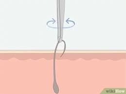 Here, a medical expert explains why ingrown ingrown pubic hairs can take anywhere from days to weeks to heal, depending on the amount of inflammation and how many hair follicles are involved. How To Get Rid Of Ingrown Pubic Hair With Pictures Wikihow