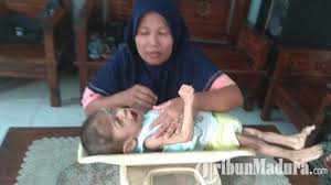 Atau mungkin ketuban warnanya ijo, memang warna ketuban yang normal air ketuban merupakan salah satu elemen yang sangat penting selama kehamilan air ketuban adalah hal yang tak lagi asing. Keracunan Air Ketuban Tubuh Balita Di Mojokerto Ini Hanya Tinggal Tulang Dan Kulitnya Saja Halaman All Tribun Madura