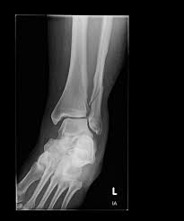 Image result for Ankle XRay