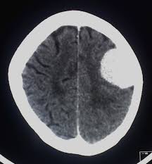 However, the ct scan can be used as part of a diagnostic assessment if a brain tumor is suspected. Meningioma Wikipedia