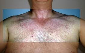 It's highly contagious and easily transmittable. Tropische Virusinfektionen Ubersicht Und Trends Im Jahr 2016 17 Fachportal Fur Wehrmedizin Wehrpharmazie