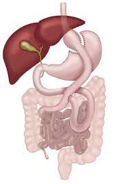 Der Magenbypass Adipositaszentrum Limmattal