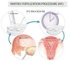 In Vitro Fertilisation Ivf Procedure Treatment Seng Clinic
