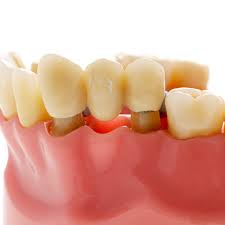 Does getting a crown hurt afterwards. Dental Bridge Types Advantages Disadvantages