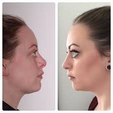 Charles East (@rhinoplastyking)