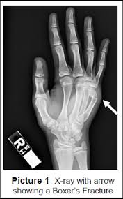 Generally after three weeks, the bone is strong enough that the. Boxer S Fracture