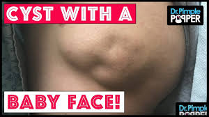 An Amazing Baby Faced Cyst Youtube Pimples Skin Care Acne Skin Care Secrets