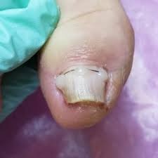 Image result for Akutní zánět nehtového lůžka