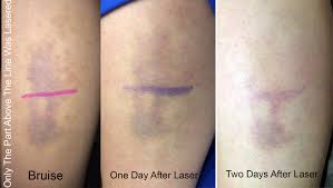 Start the treatment by applying ice on the injured part of the face. Laser That Gets Rid Of Bruises