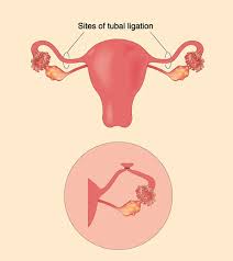 Pregnancy After Tubal Ligation Signs Symptoms And Risks