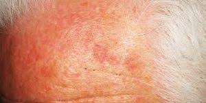 While typically melanoma tumors are dark in color, occasionally they can present as lighter colors such as white, pink, blue or skin. What Is An Ak Actinic Keratosis