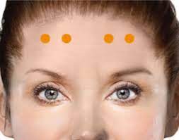 For many stars botox before and after pictures is the norm. Chronic Migraine Injection Sites Botox Onabotulinumtoxina For Medical Professionals