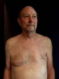 Some men develop rarer types of breast cancer, such as inflammatory breast cancer. Male Breast Cancer Survivor Calls For More Awareness Abc News