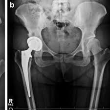 The Depuy Pinnacle Acetabular Component With Neutral Polyethylene Liner Download Scientific Diagram