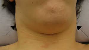 Mouth Sores Pictures Causes Types Symptoms And Treatments Swollen Lymph Nodes Mouth Sores Mouth Sores Causes