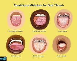 Image result for Oral thrush roof of mouth