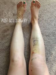 French Press Runner Life After Acl Surgery Acl Surgery Acl Surgery Recovery Acl Recovery