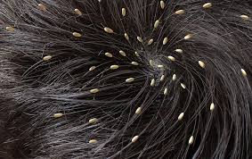 Image result for lice vs dandruff