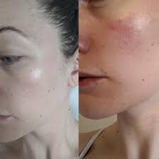 Then, 4 to 5 years ago, i heard about soolantra, i got it on prescription and since then i haven't used anything else, it's brilliant, it works quickly and the redness and pustules reduce within 2 days. Before Right And After Left 6 Weeks Of Rosiver Canadian Version Of Soolantra Rosacea