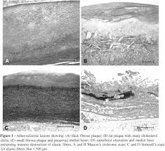 Scielo Brasil Different Patterns Of Atherosclerotic Remodeling In The Thoracic And Abdominal Aorta Different Patterns Of Atherosclerotic Remodeling In The Thoracic And Abdominal Aorta