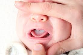 Nyeri di tenggorokan adalah satu gejala yang paling umum. Jangan Panik Ini Cara Tepat Mengatasi Radang Tenggorokan Pada Bayi Bukareview