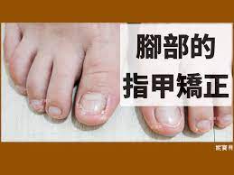 腳部指甲矯正-腳趾甲問題的成因與處- 妮寶貝指甲