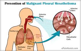 Mesothelioma pain management involves a combination of treatments, medications and other complementary care. Life Expectancy In Malignant Pleural Mesothelioma Its Prognosis And Prevention