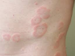 How long for a drug rash to go away. Drug Induced Urticaria Dermnet Nz