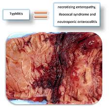 Image result for Neutropenic Colitis