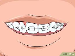 Jan 15, 2021 · penerapan dinding berwarna teal adalah langkah pertama yang boleh anda cuba untuk membawa suasana pantai ke kediaman anda. Cara Memilih Warna Behel Kawat Gigi 14 Langkah Dengan Gambar