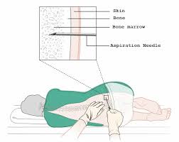Image result for Bone Marrow Exam