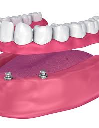 However, most of the time the cost of both permanent and removable dentures can vary according to the geographical location, dentist and the techniques here is how you can break down the cost. Permanent Dentures Cost Los Angeles What Is The Price Of Permanent Dentures