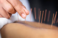 Acupuncture - Boucher Naturopathic Medical Clinic