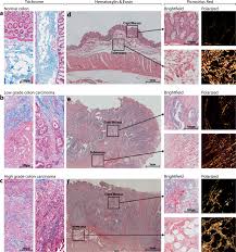 Intestinal tumors are uncommon in dogs. Simulating The Human Colorectal Cancer Microenvironment In 3d Tumor Stroma Co Cultures In Vitro And In Vivo Scientific Reports