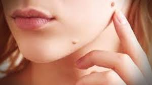 Menghilangkan tahi lalat tidaklah semudah yang dibayangkan, cara tercepat untuk menghilangkan tahi lalat adalah dengan melalui perawatan dokter obat ini digunakan untuk menghilangkan tahi lalat dan kutil. Cara Menghilangkan Tahi Lalat Di Baju