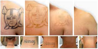 We remove or lighten unwanted tattoos. Laser Tattoo Removal