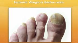 Thick yellow toenails have many medical causes. Why Do Toenails Turn Yellow Healthier Land