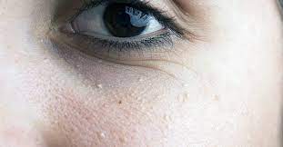 Sanitize a sharp needle (the finer point the better) and tweezers or comedone extractor. Milia Under Eyes Causes Diagnosis And Treatment