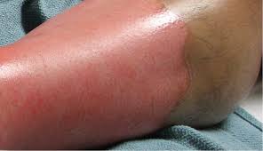 Traditionally, burns are characterized by degree. Outpatient Burns Prevention And Care American Family Physician
