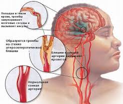 Lechenie I Prichiny Ateroskleroticheskih Blyashek V Sonnyh Arteriyah Oficialnyj Sajt Gbuz Rodilnyj Dom 2 G Magnitogorsk