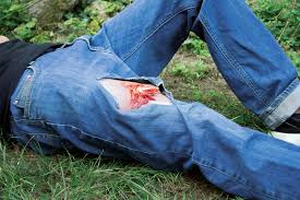 Image result for Open Fracture