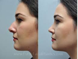 You might also get one across the skin between the nostrils. Rhinoplasty Houston Nose Job Surgeon Houston Tx Funk Facial Plastic Surgery