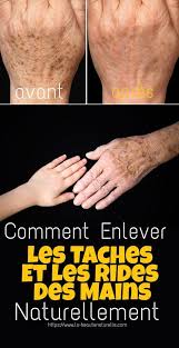Epingle Sur Taches Brunes Sur Les Mains
