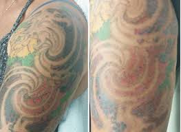 See reviews, photos, directions, phone numbers and more for the best tattoo removal in big rapids, mi. 5 Important Facts Those In Laser Tattoo Removal Courses Can T Ignore International Beauty Institute