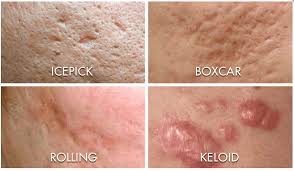 Cara menghilangkan jerawat yang mudah dan ampuh. Jenis Dan Cara Hilangkan Parut Jerawat Messarah