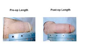 Enlarge Erect Penis Penile Girth Enlargement Enlarge Flaccid Penis Penile Enlargement Surgery
