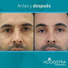 Cirurgia Palpebral Blefaroplastia A Laser Operacao De Palpebras Caidas Buenos Aires Hoogstra