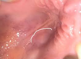 Image result for Canker sores symptoms roof of the mouth